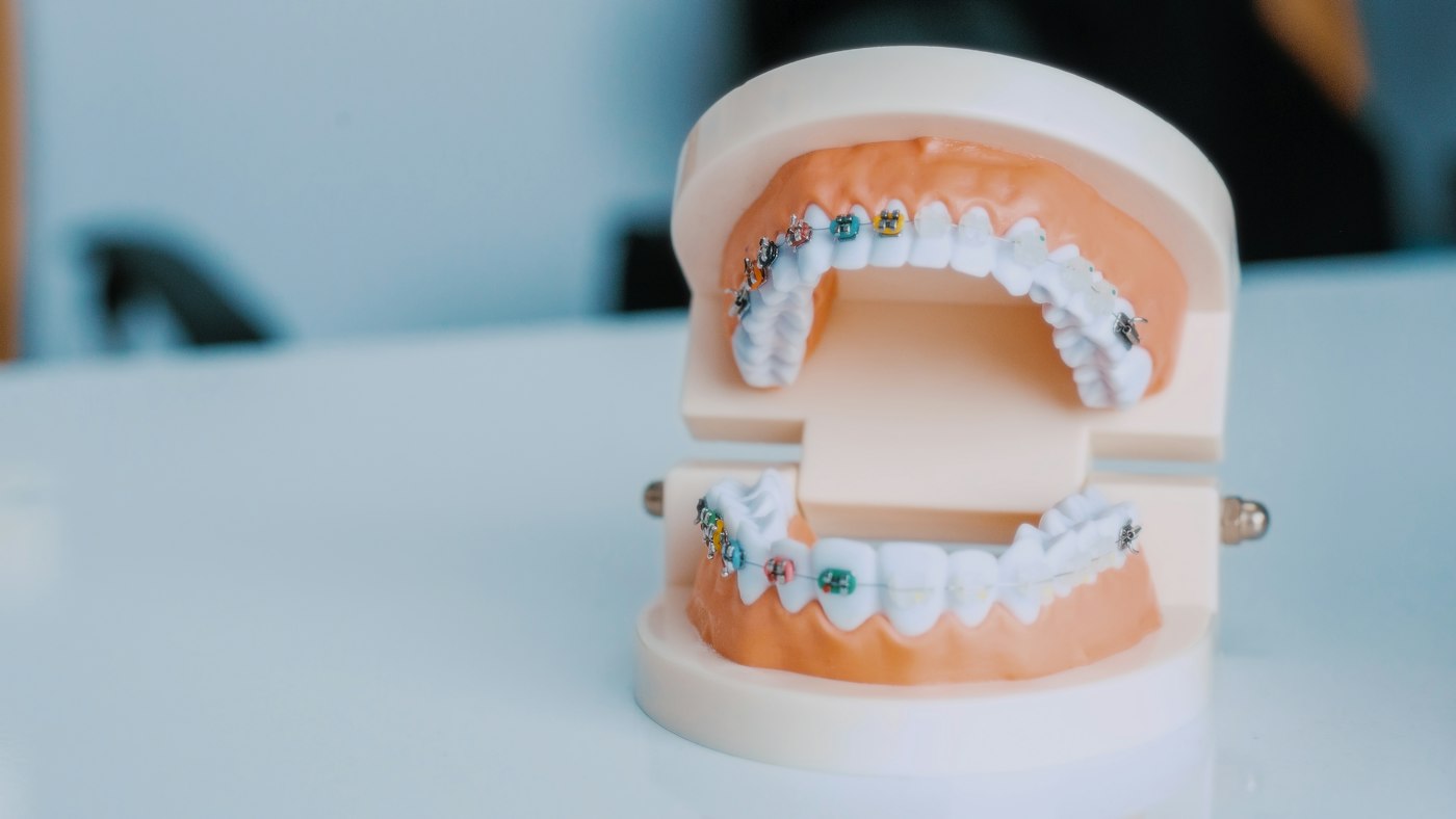 Close-up of a dental model showing upper and lower teeth